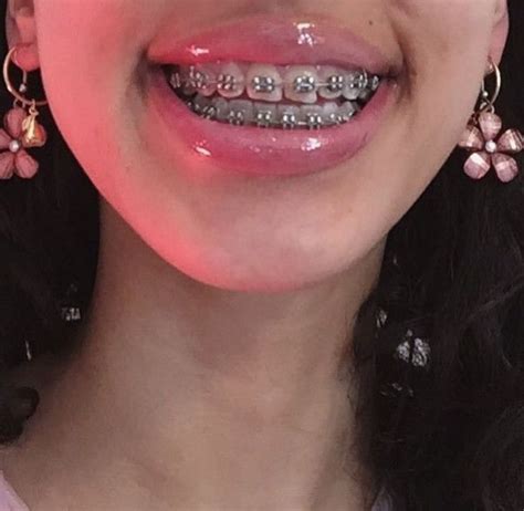 aesthetic braces colours.